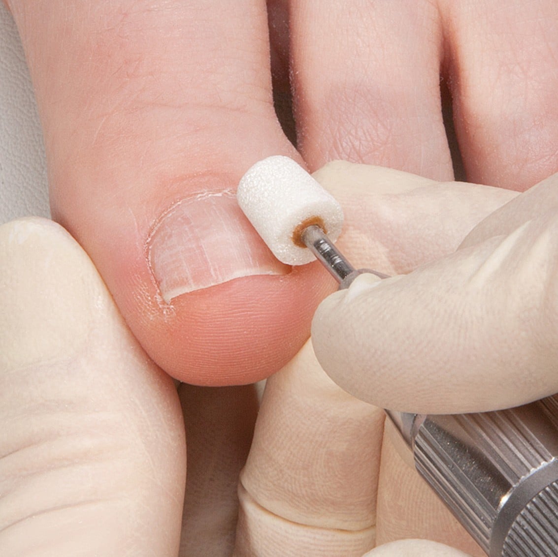 Mini set per correzzione estetica della lamina ungueale nei piedi - Tecniwork - immagine 3